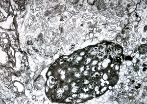 Whipple disease Whipple disease